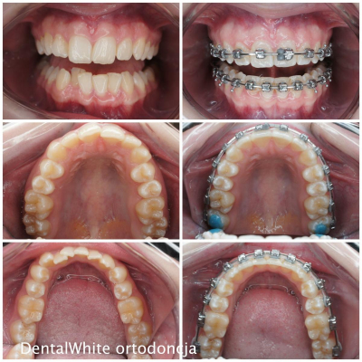 ortodoncja-DentalWhite-6