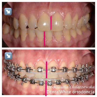 ortodoncja-DentalWhite