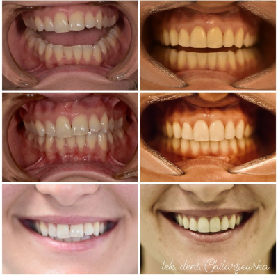 ortodoncja-DentalWhite-
